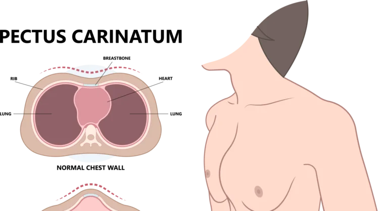 pectus carinatum