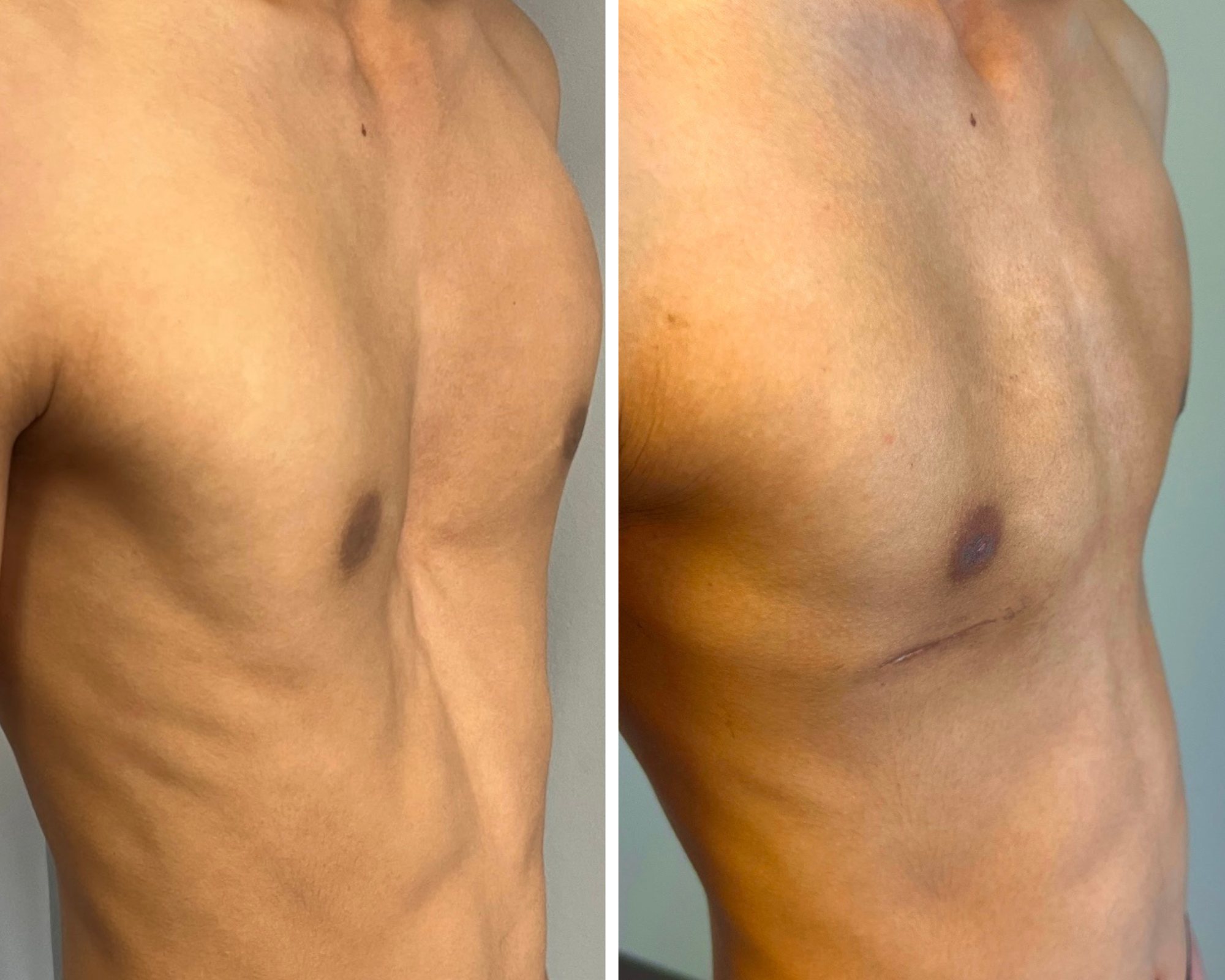 Adam's chest before and after surgery