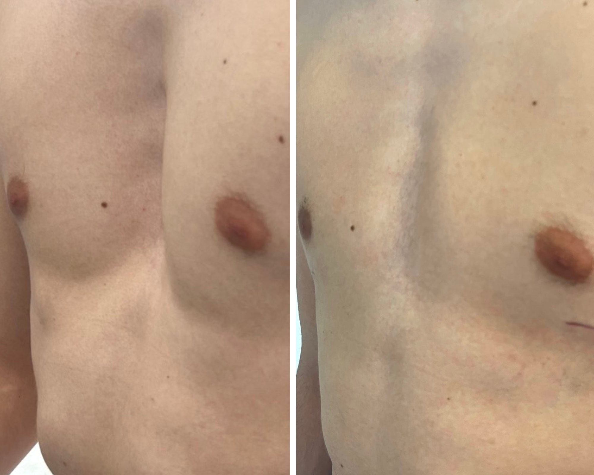 Brandon's chest before and after surgery