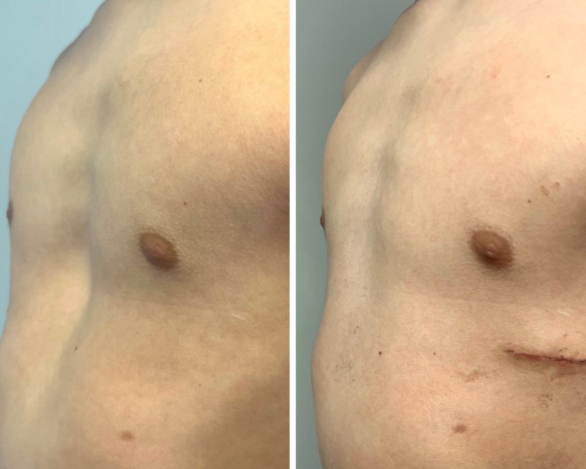 Cooper's chest before and after surgery