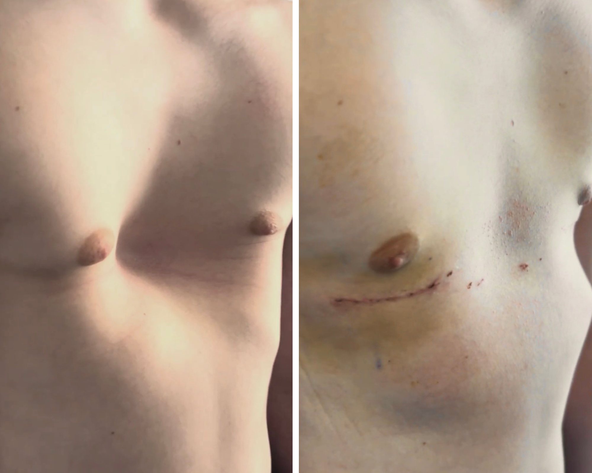 Declan's chest before and after surgery