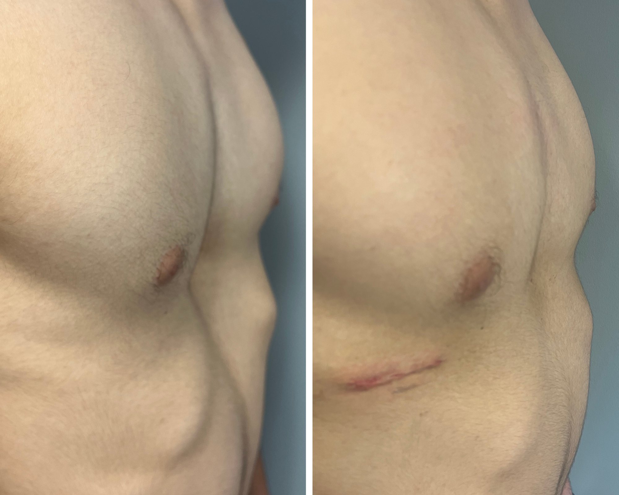 Khalifa's chest before and after surgery