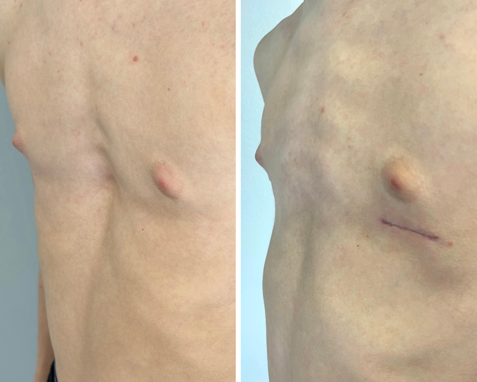 Michael's chest before and after surgery