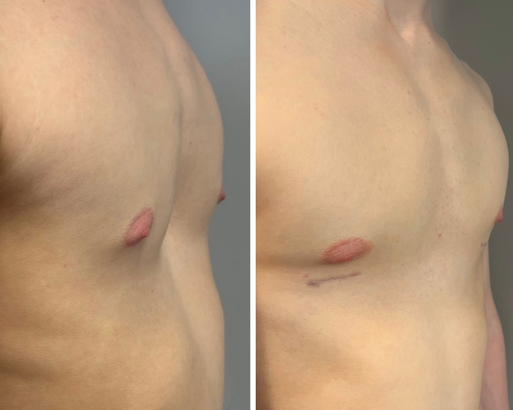 Nickolas's chest before and after surgery