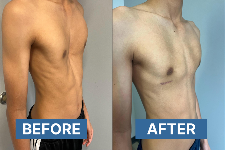 before and after pectus excavatum surgery